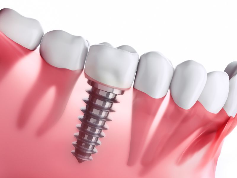 implantes de carga inmediata