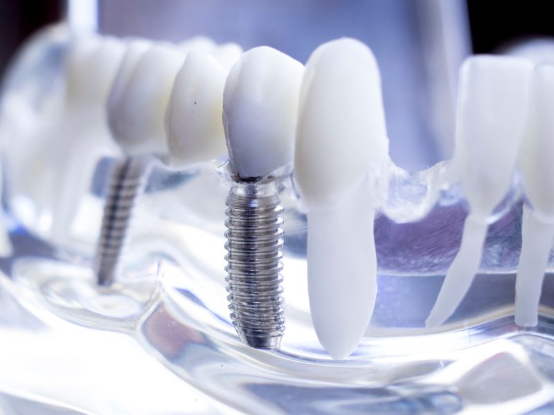 implantes dentales